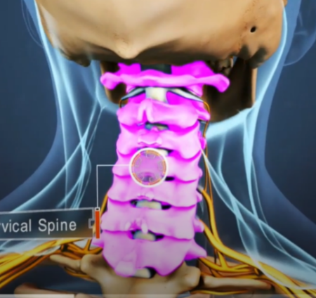 Cervical pain