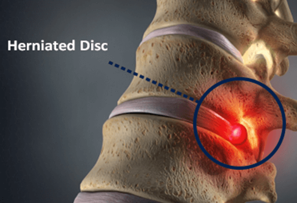 Herniated Disc Symptoms