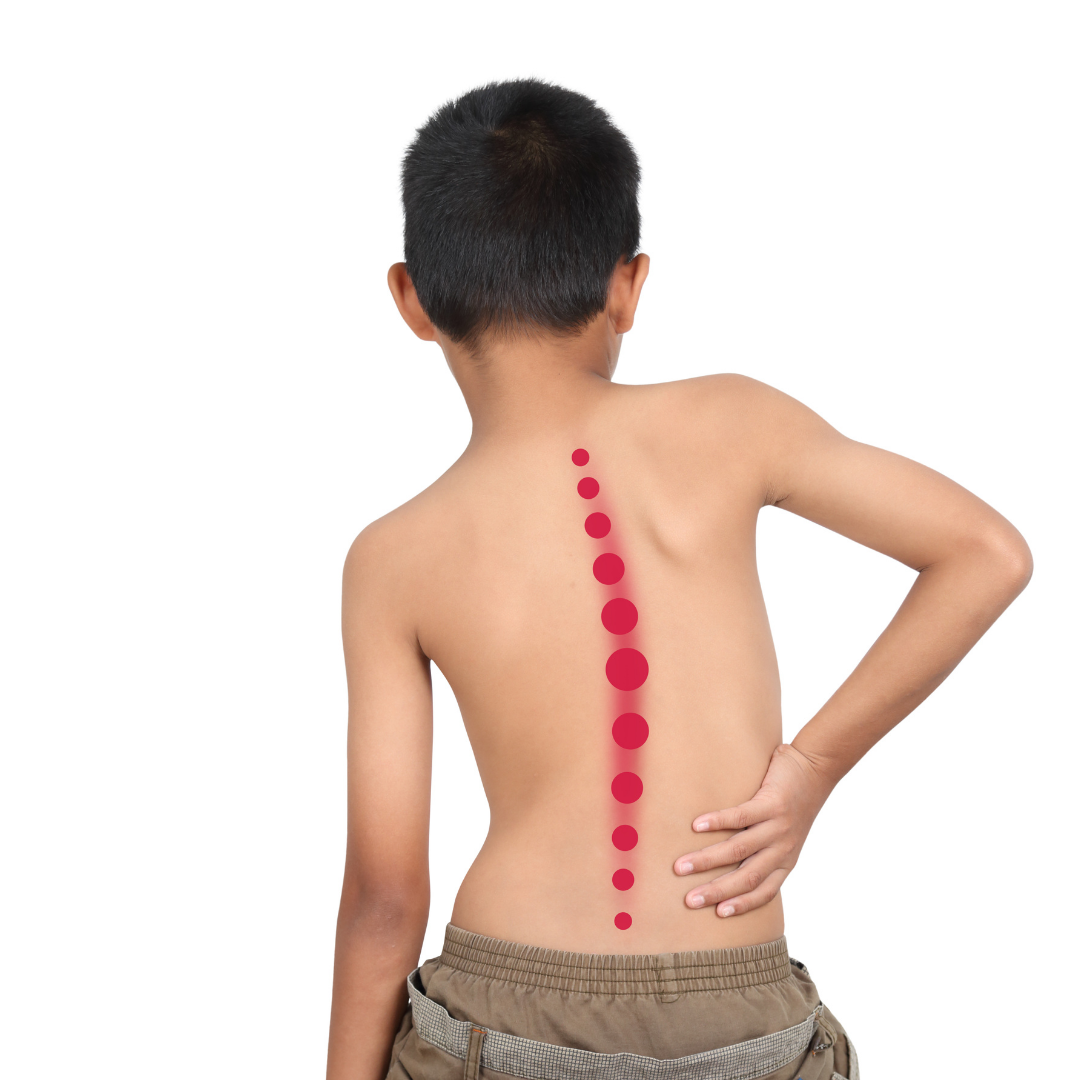 Types of Scoliosis