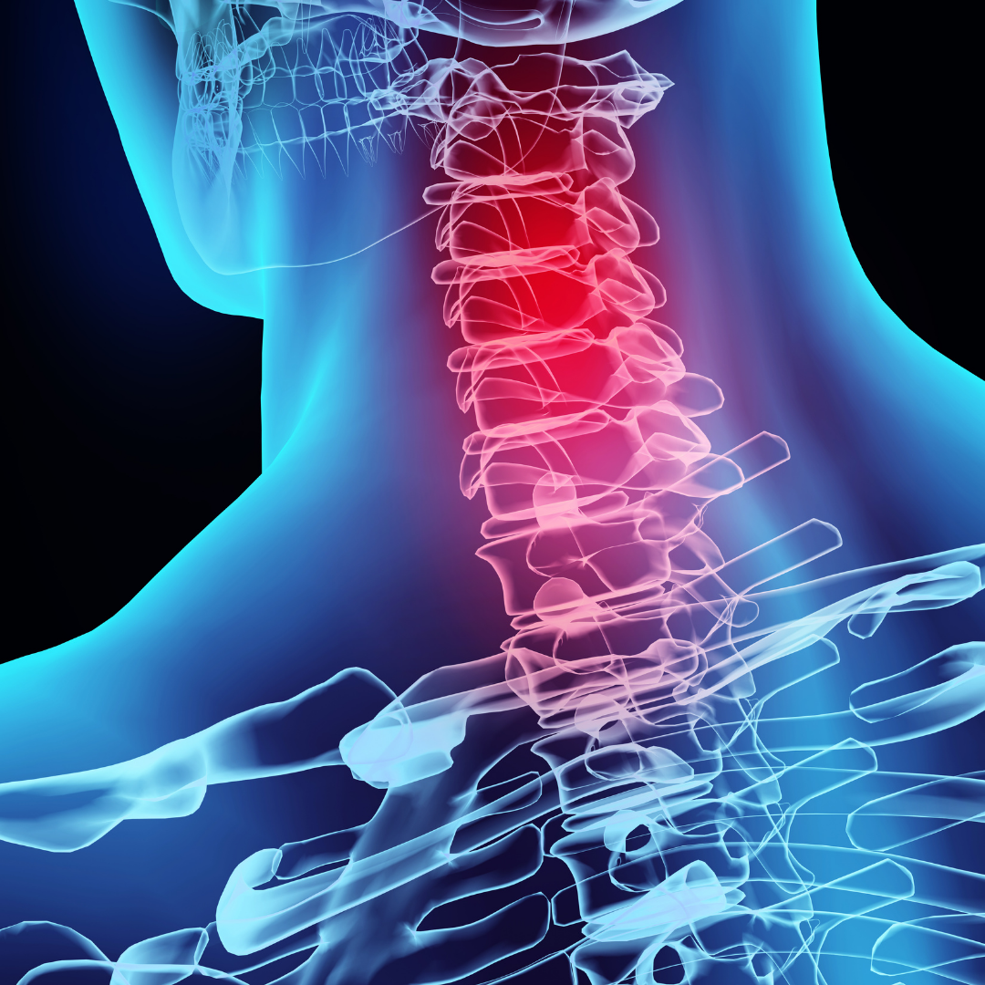 How Does a Chiropractor Help Treat Whiplash?