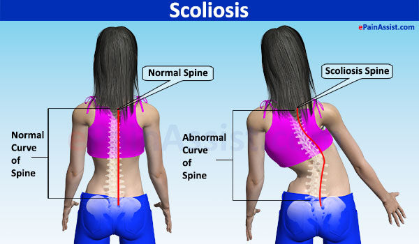 What Causes Scoliosis?