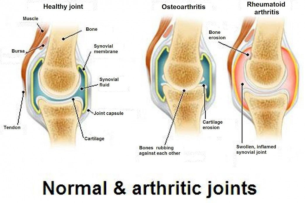 The major complaint by individuals who have arthritis is pain.