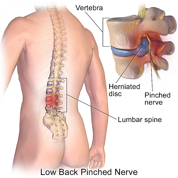 What Is a Herniated Disc?