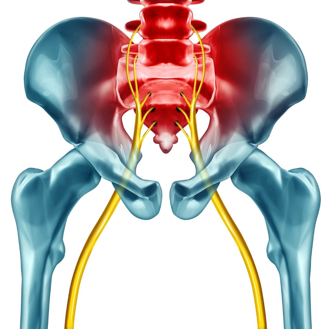 What is Sciatica?