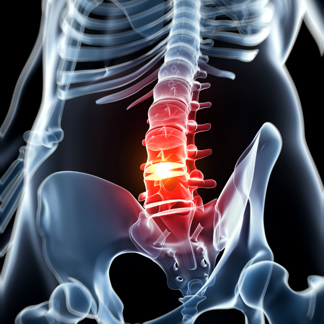 What Causes Spinal Disc Problems?